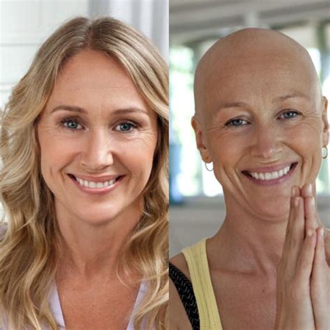 Strålning bröstcancer tappa håret